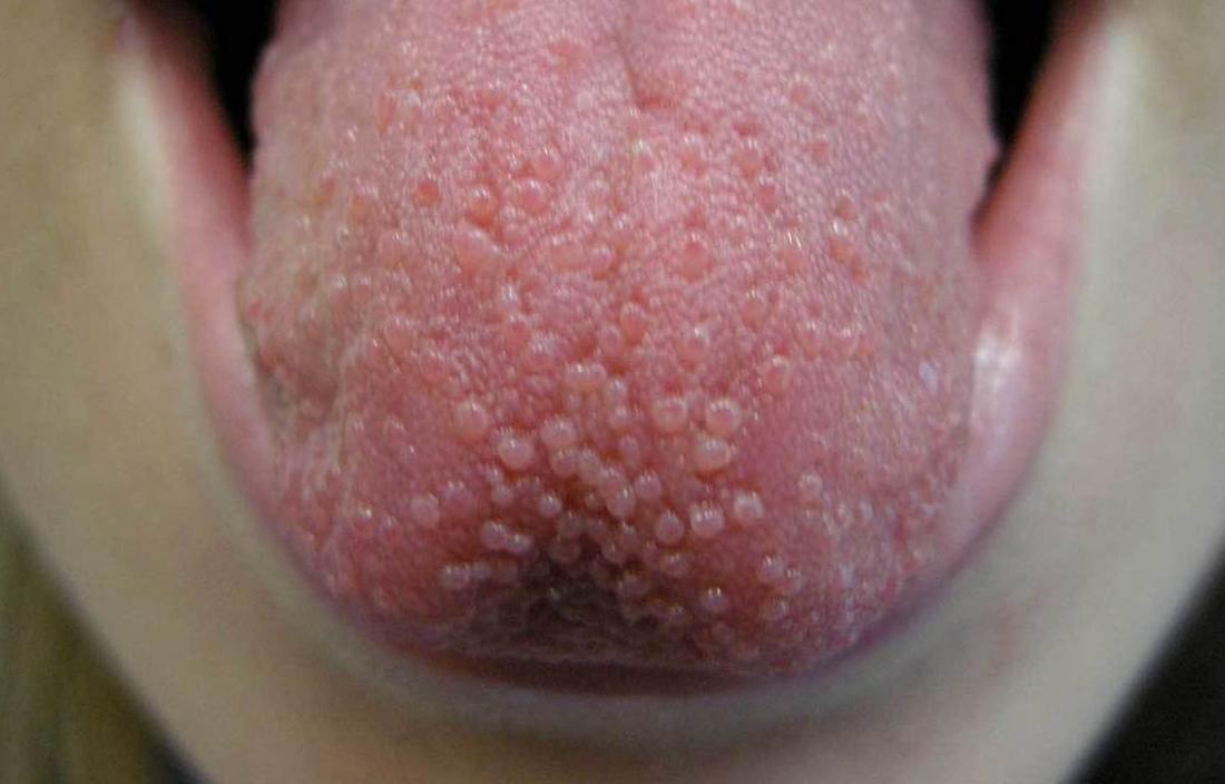 Causes of Chlamydia bumps on the tongue